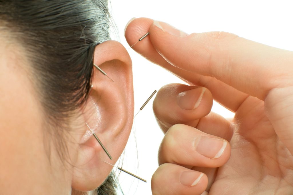 ear acupuncture Long Island NY