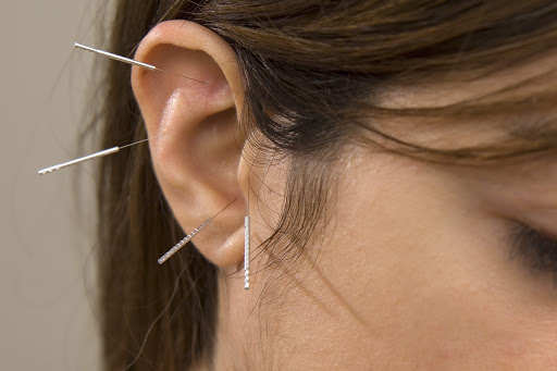 ear acupuncturist Long Island