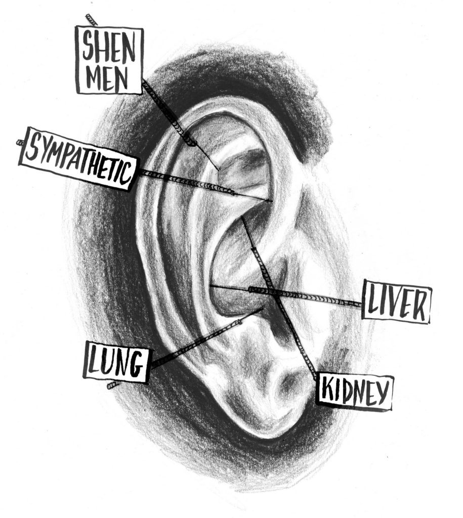 ear acupuncture long island
